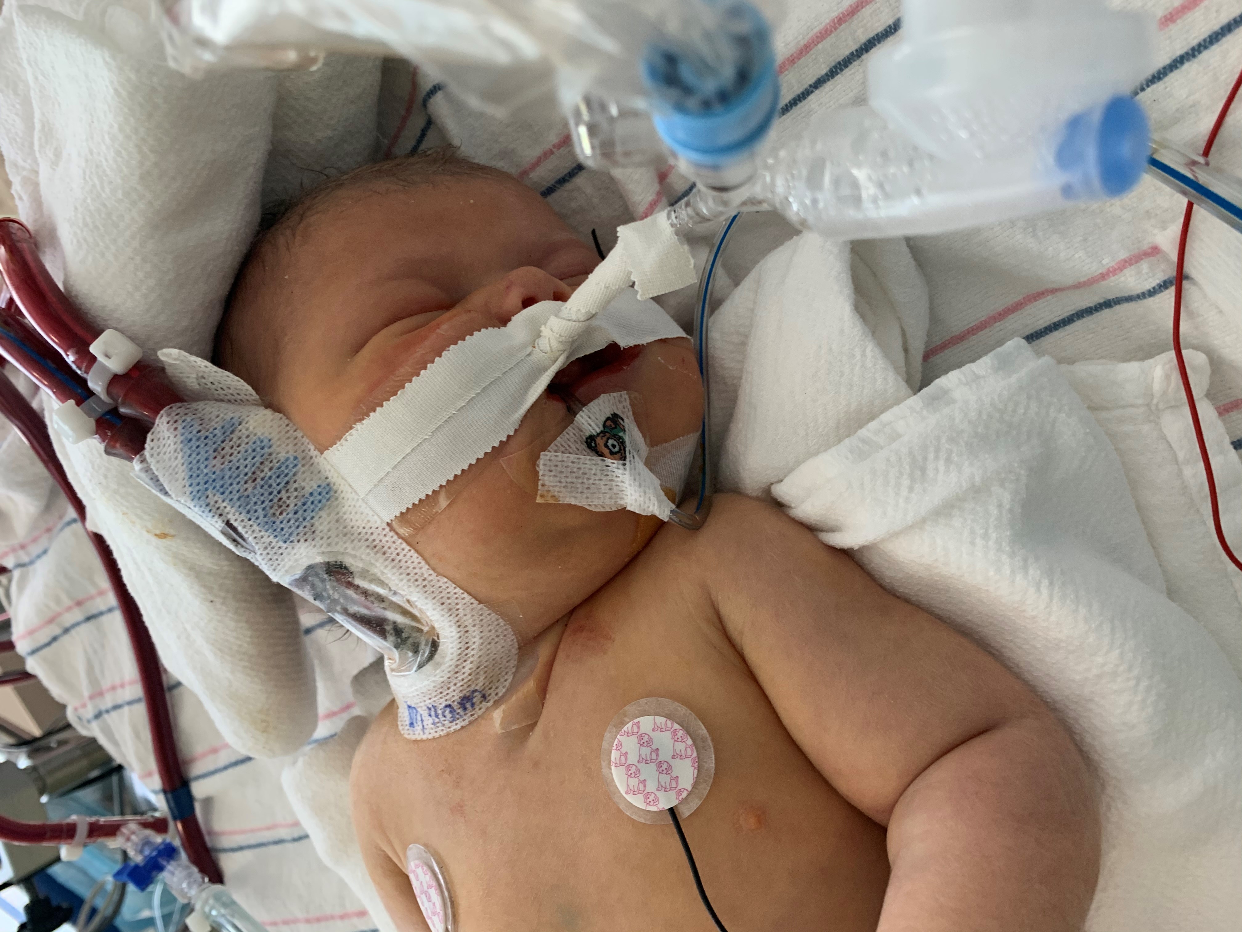 Baby Pierce with on ventilator