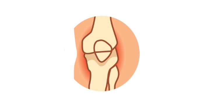 Numero 11: Dolor en las articulaciones - El exceso de peso puede forzar las articulaciones, provocando dolor y rigidez.