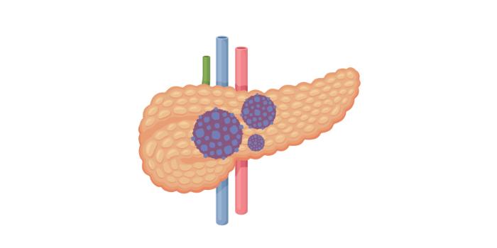 Numero 12: Cáncer - La obesidad está asociada con cánceres como el de hígado, riñón, colon y páncreas, entre otros.