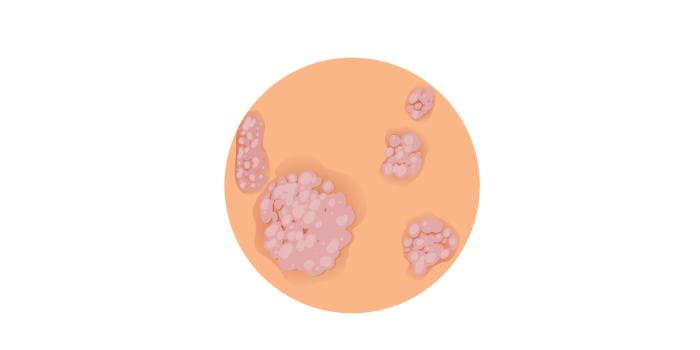 Number 9: Skin Fold Rashes - Discolored and thickened rashes may occur at skin folds and creases.